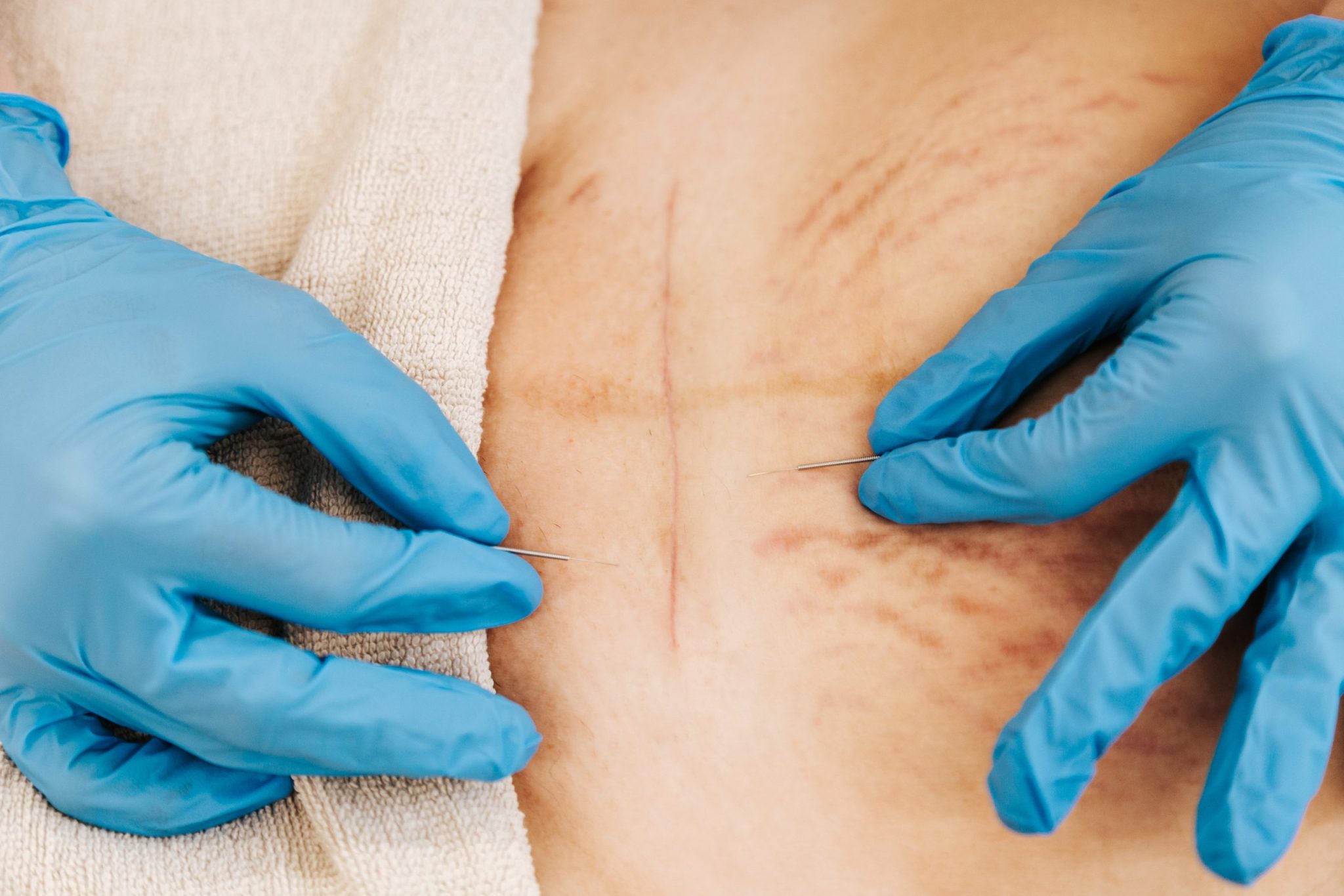 tratamiento cicatrices villafranca castellon