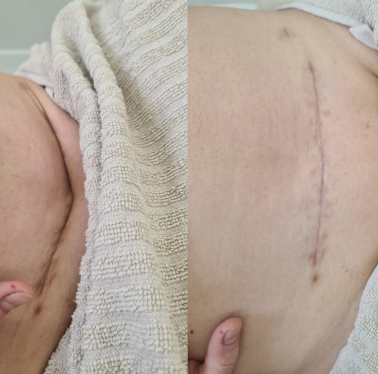 tratamiento cicatrices villafranca