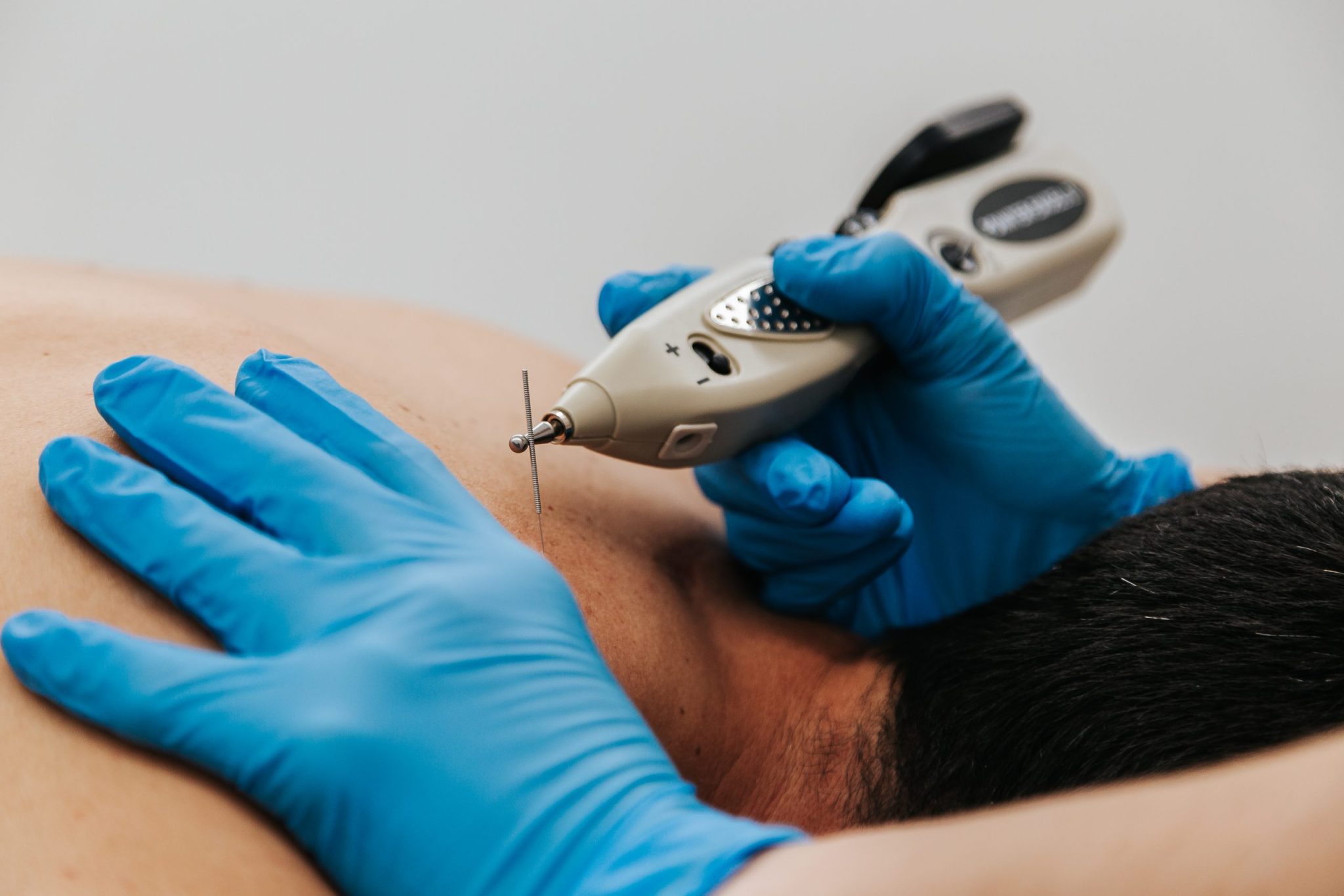 Terapia de acupuntura en un paciente con agujas.